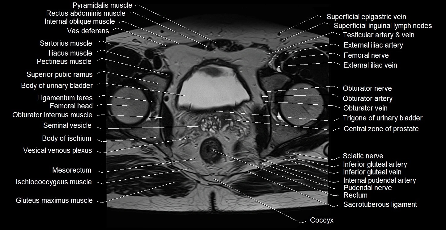 Male pelvis axial cross sectional anatomy image 27.webp